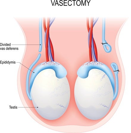Vasectomy Diagram