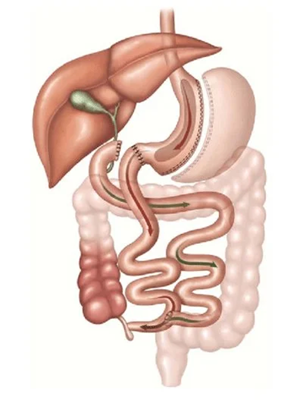 Duodenal Switch Illustration