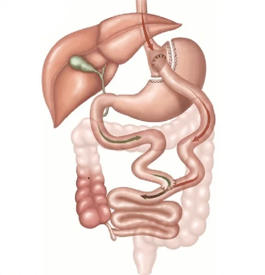 Gastric Bypass Illustration